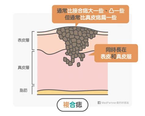 複合痣 紫氣東來意思